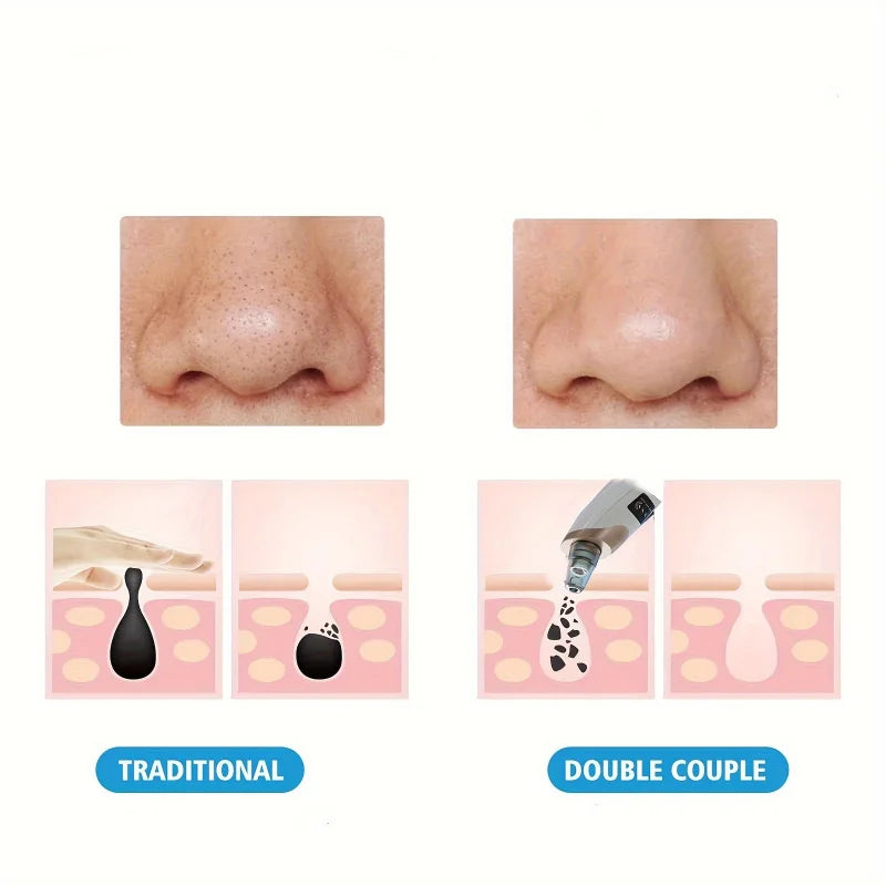 Blackhead Remover Pore Vacuum - 5 Suction Modes USB Rechargeable Facial Pore Cleaner Kit